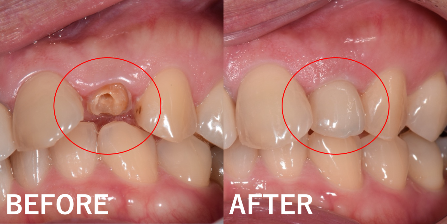 【症例】欠けた前歯をジルコニアセラミックにて修復
