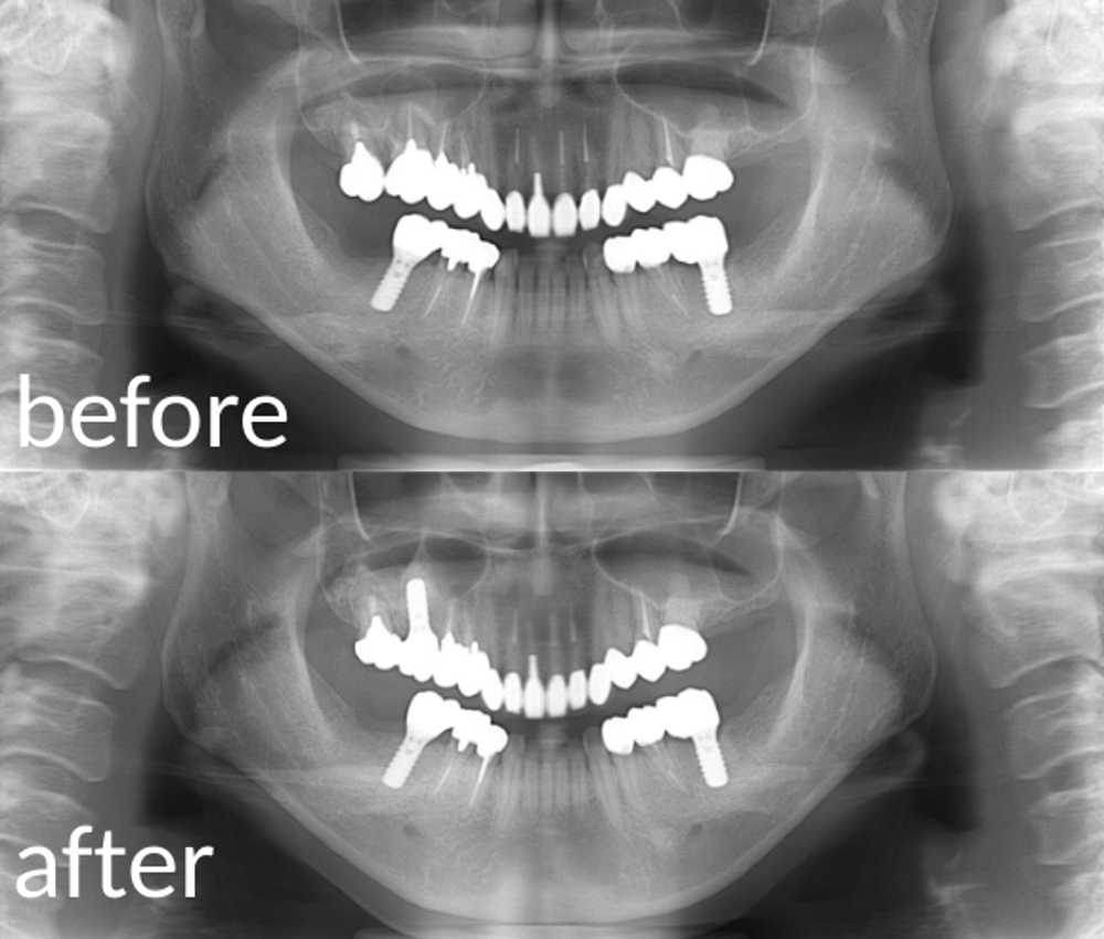 【症例】抜歯・歯根嚢胞除去後、骨造成を行ってからインプラントで治療