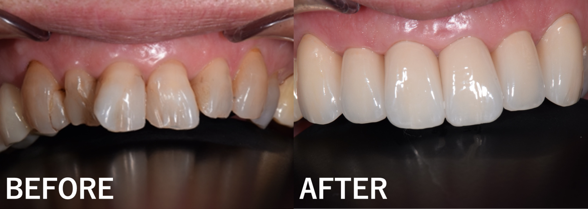 【症例】コンポジットレジンで修復を繰り返していた前歯をジルコニアセラミック治療で歯並びまで改善