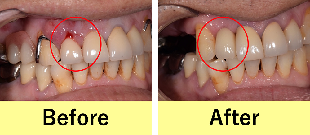 【症例】歯根破折した前歯を抜歯後インプラントを埋入した審美治療