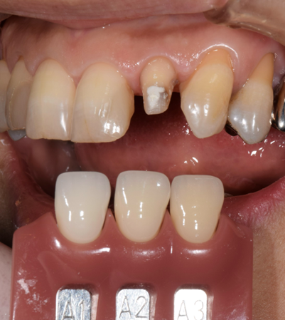 色合わせ画像｜【症例】コンポジットレジンとジルコニアによる前歯の修復治療｜桜木町の歯医者「みらい歯科」