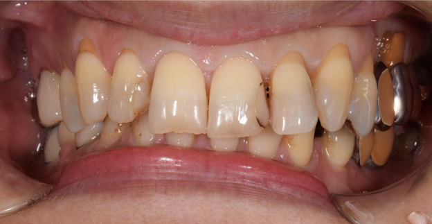 治療前画像｜【症例】コンポジットレジンとジルコニアによる前歯の修復治療｜桜木町の歯医者「みらい歯科」