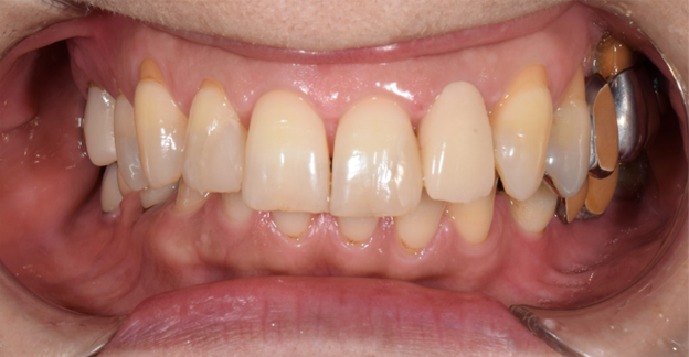 治療後画像｜【症例】コンポジットレジンとジルコニアによる前歯の修復治療｜桜木町の歯医者「みらい歯科」