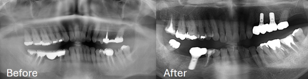 【症例】80歳からのインプラント治療：入れ歯の悩みを解消し、健康長寿を支える選択
