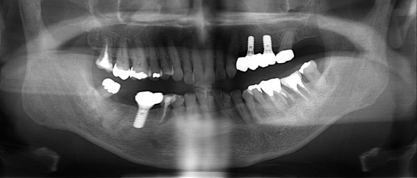 治療後レントゲン画像｜【症例】80歳で入れ歯からインプラントにやりかえ治療【症例】80歳からのインプラント治療：入れ歯の悩みを解消し、健康長寿を支える選択｜桜木町の歯医者「みらい歯科」