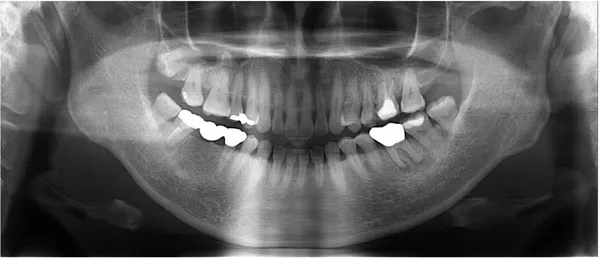 治療前口腔内レントゲン画像|【症例】欠けた前歯をジルコニアセラミックにて治療|桜木町の歯医者「みらい歯科」