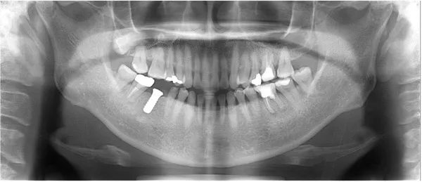 インプラント埋入後口腔内レントゲン画像|【症例】欠けた前歯をジルコニアセラミックにて治療|桜木町の歯医者「みらい歯科」