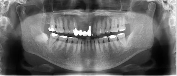 治療前口腔内レントゲン画像1｜【症例】噛み合わせが強く歯周病と歯根破折を招いた歯に対するインプラント治療｜桜木町の歯医者「みらい歯科」
