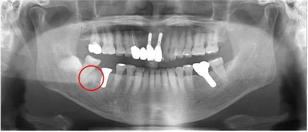 右下インプラント埋入後レントゲン画像|【症例】噛み合わせが強く歯周病と歯根破折を招いた歯に対するインプラント治療|桜木町の歯医者「みらい歯科」