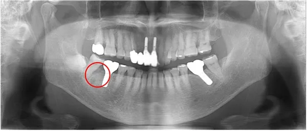右下被せ物後レントゲン画像|【症例】噛み合わせが強く歯周病と歯根破折を招いた歯に対するインプラント治療|桜木町の歯医者「みらい歯科」