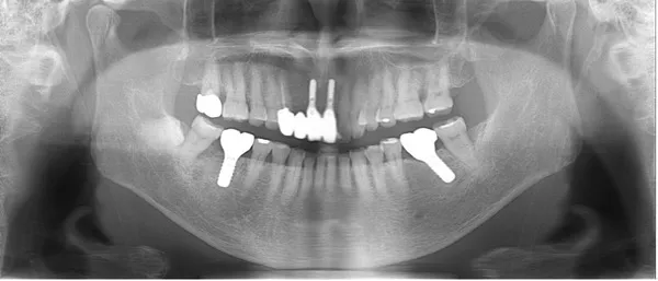 治療後口腔内レントゲン画像|【症例】噛み合わせが強く歯周病と歯根破折を招いた歯に対するインプラント治療|桜木町の歯医者「みらい歯科」