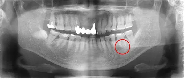 治療前口腔内レントゲン画像2|【症例】噛み合わせが強く歯周病と歯根破折を招いた歯に対するインプラント治療|桜木町の歯医者「みらい歯科」