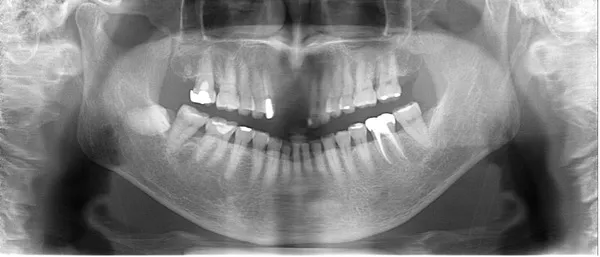 前歯抜歯後レントゲン画像|【症例】噛み合わせが強く歯周病と歯根破折を招いた歯に対するインプラント治療|桜木町の歯医者「みらい歯科」