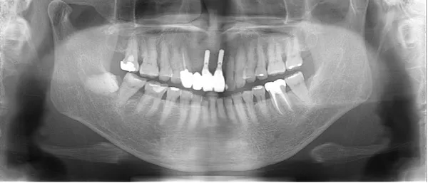 前歯被せ物後レントゲン画像|【症例】噛み合わせが強く歯周病と歯根破折を招いた歯に対するインプラント治療|桜木町の歯医者「みらい歯科」