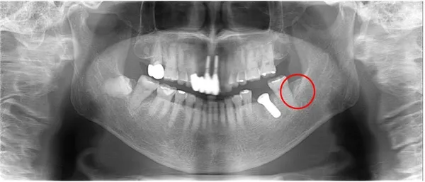 左下インプラント埋入後レントゲン画像|【症例】噛み合わせが強く歯周病と歯根破折を招いた歯に対するインプラント治療|桜木町の歯医者「みらい歯科」
