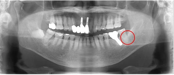 左下被せ物後レントゲン画像|【症例】噛み合わせが強く歯周病と歯根破折を招いた歯に対するインプラント治療|桜木町の歯医者「みらい歯科」