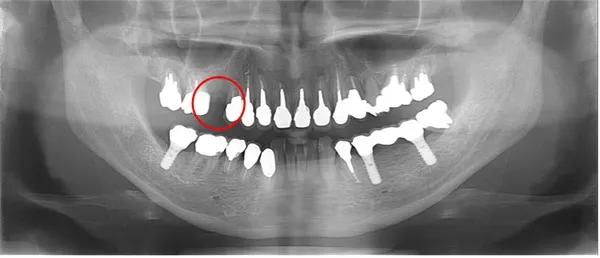 2ヶ月ごレントゲン画像 |【症例】歯根歯折をおこした上顎歯を抜歯後、大規模骨造成を行いインプラントの埋入にて治療|桜木町の歯医者「みらい歯科」