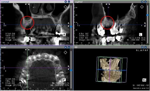 4ヶ月後CT画像2|【症例】歯根歯折をおこした上顎歯を抜歯後、大規模骨造成を行いインプラントの埋入にて治療|桜木町の歯医者「みらい歯科」