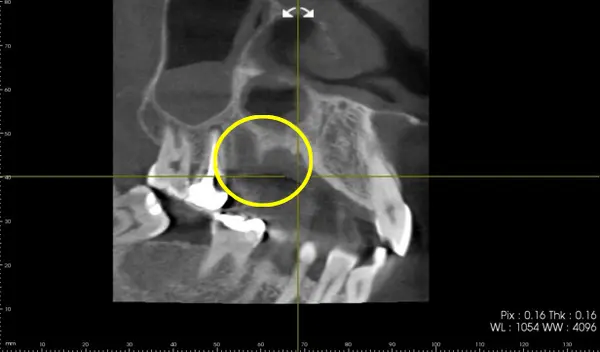 レントゲン写真part1│【症例】破折したブリッジの抜歯と骨造成を併用したインプラント治療|桜木町の歯医者「みらい歯科」